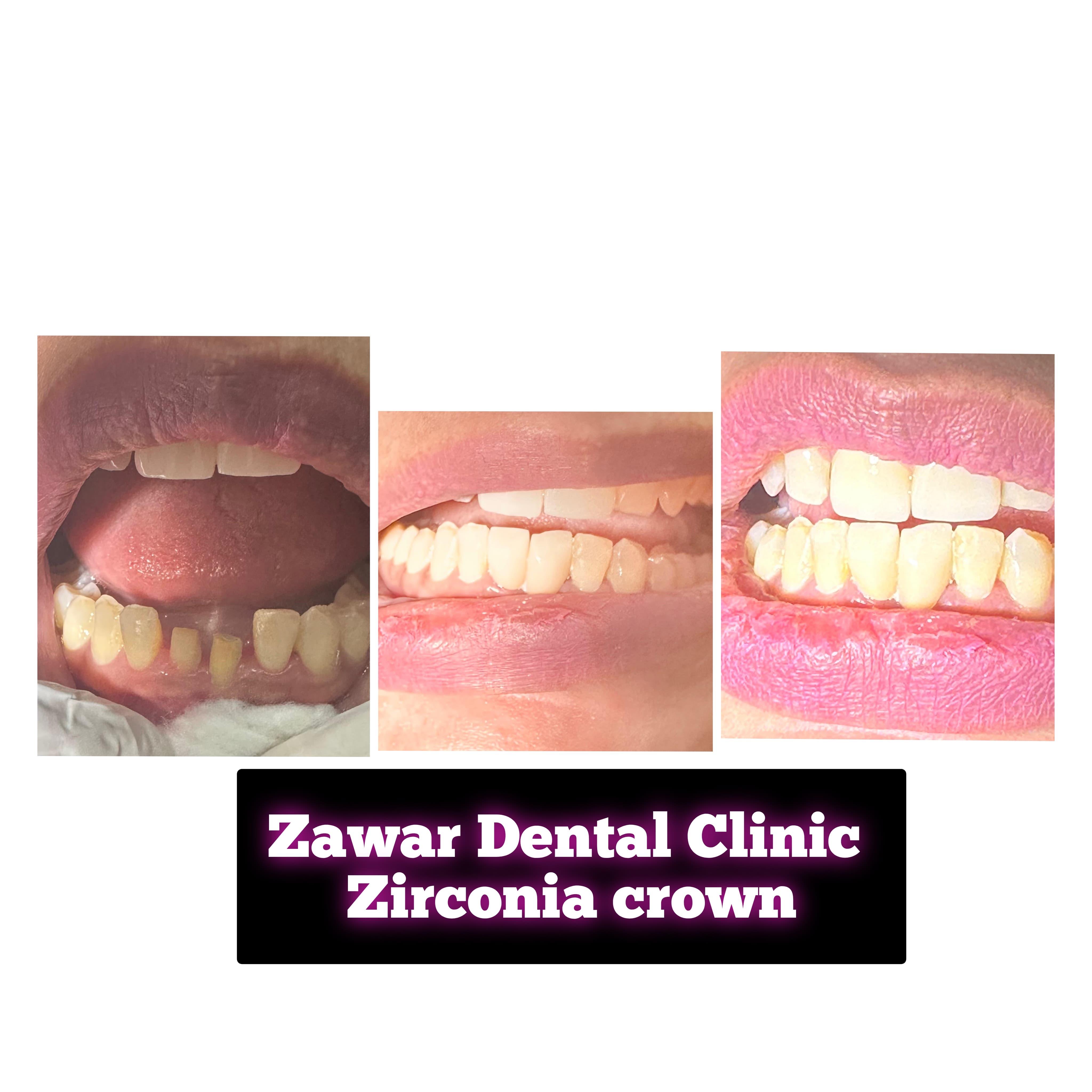 Smile transformation 4