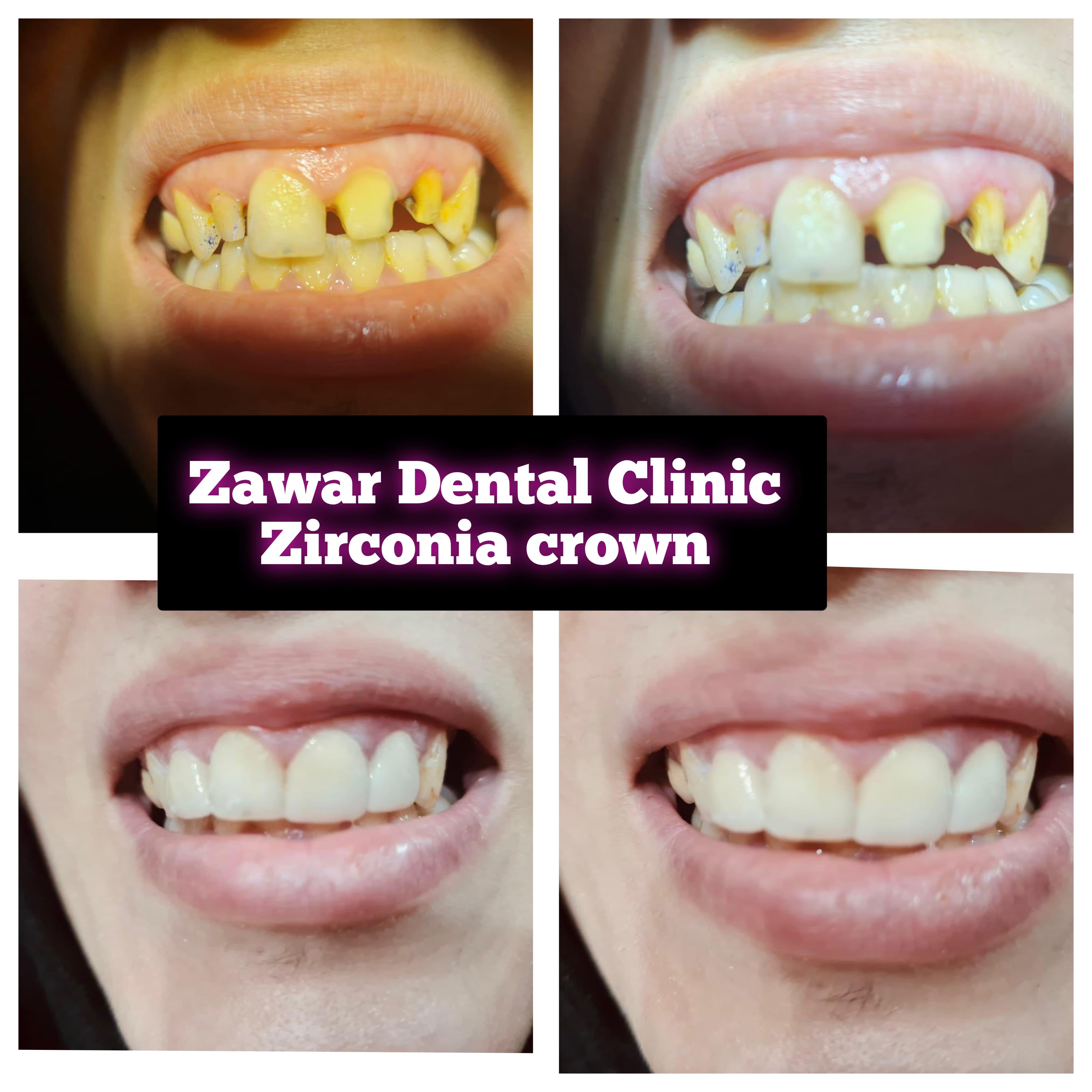 Smile transformation 6