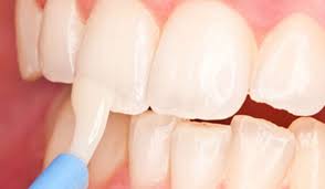 Fluoride Treatment
