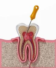 Root Canal Treatment