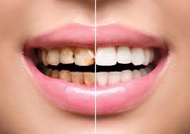 Teeth Scaling